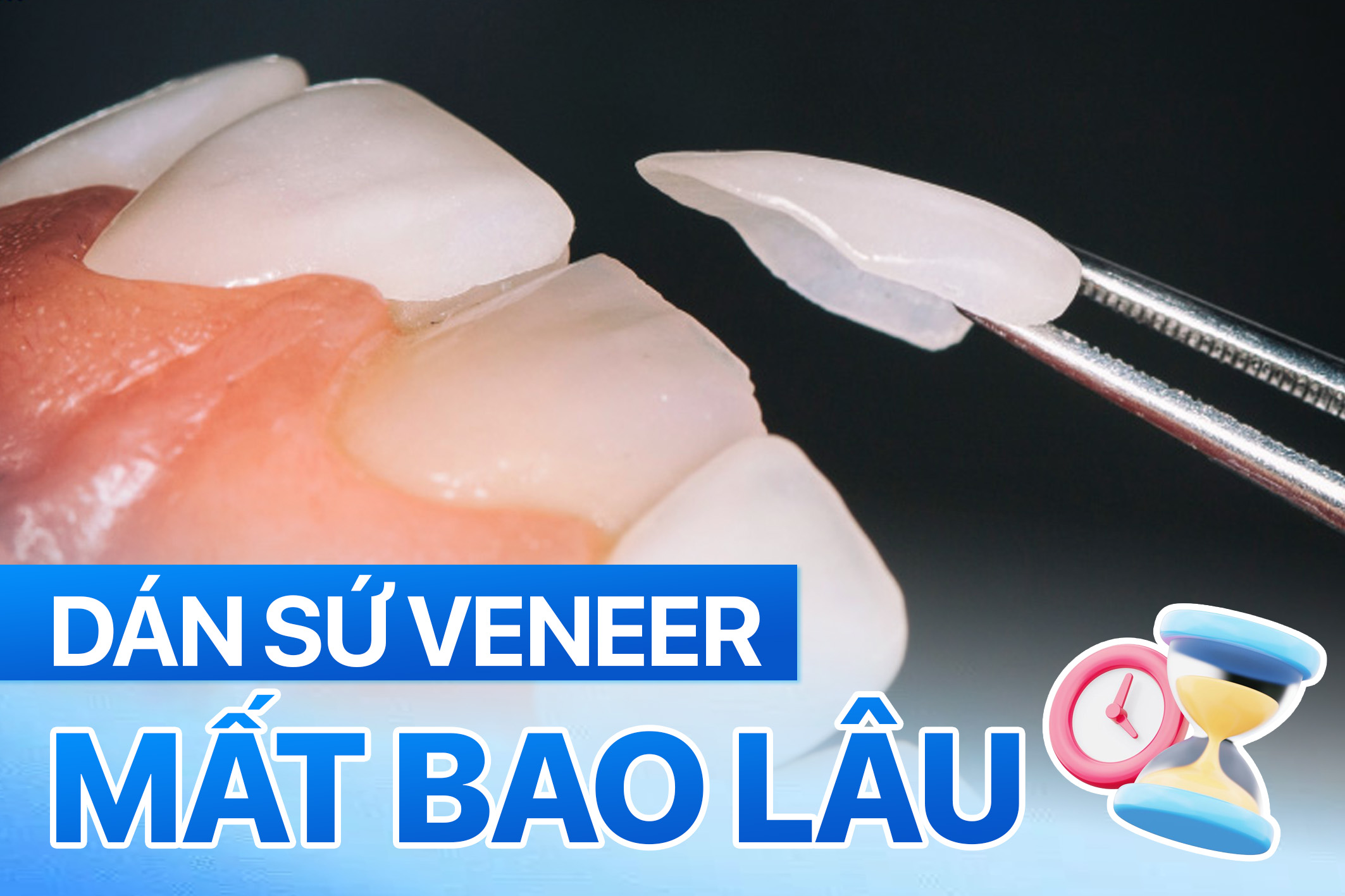Dán sứ veneer mất bao lâu thì hoàn thiện? Có phải đi lại nhiều lần không? 