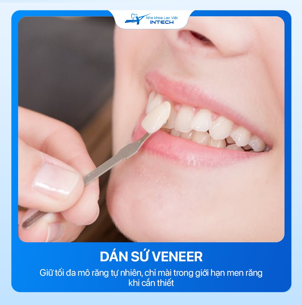 dán sứu veneer