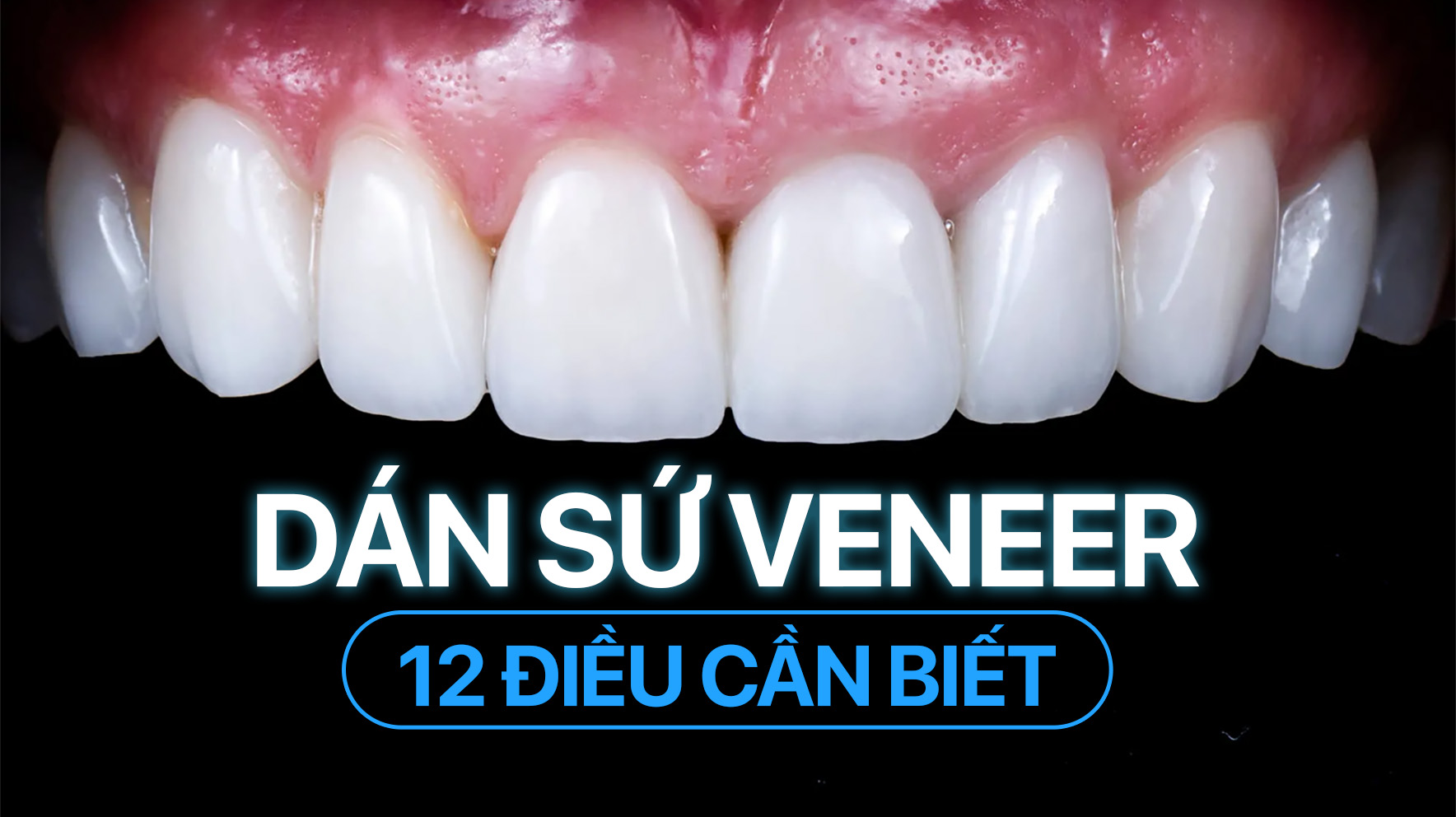 12 điều cần biết về dán sứ veneer khách hàng cần biết trước khi “xuống tiền” 
