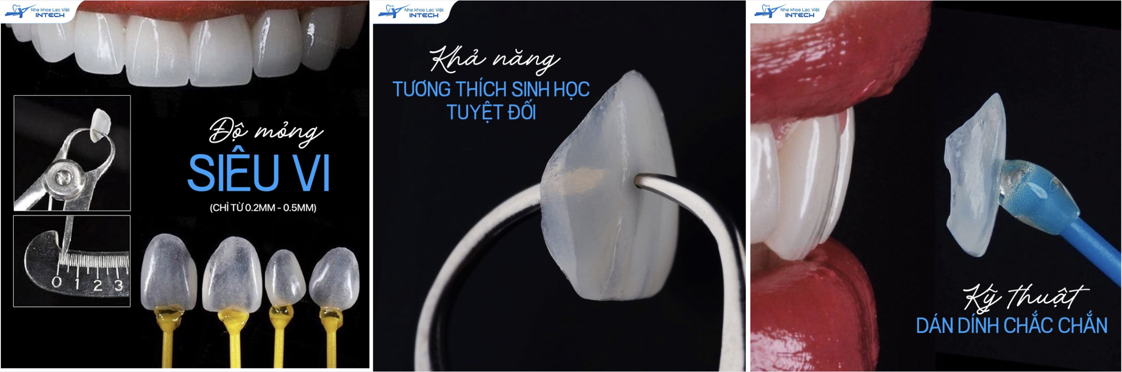 một ca dán sứ đạt tiêu chuẩn không thể nào giá quá rẻ