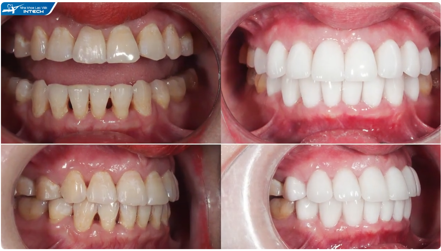 Dán Sứ Veneer Là Gì? 4 Trường Hợp Nên Dán Sứ 