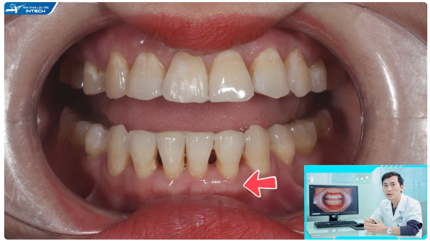 răng thưa dán sứ veneer