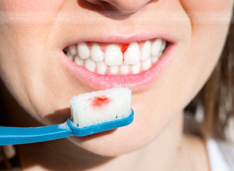 Đánh răng không đúng cách khiến nướu tổn thương