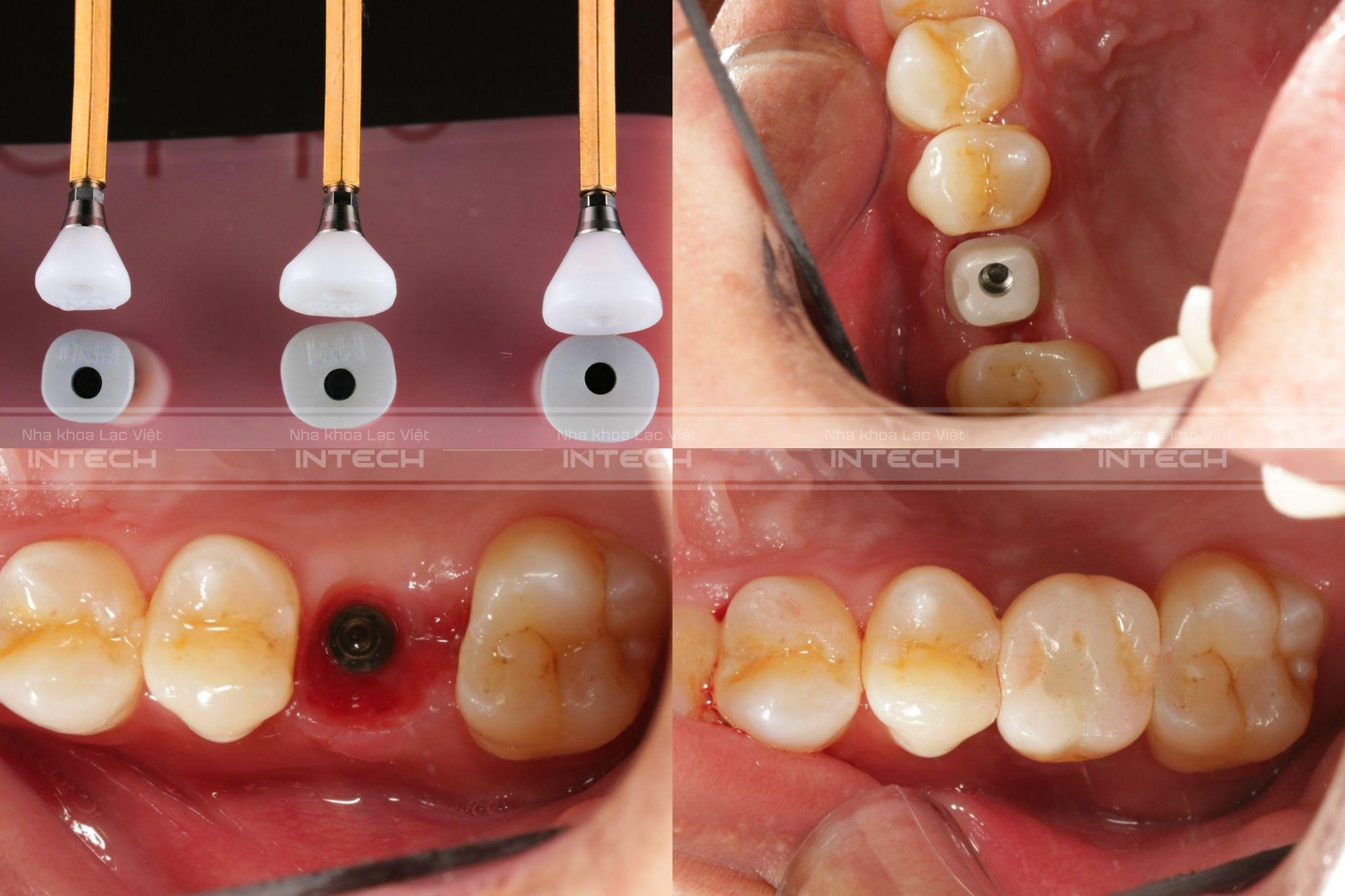 Đặt trụ lành thương định hình nướu, sau đó gắn abutment và răng sứ.