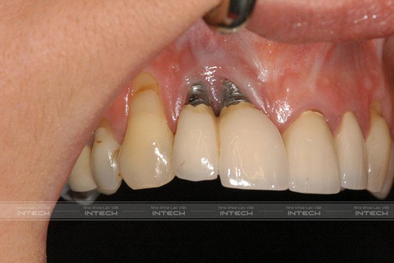 Tình trạng răng Implant bị đào thải gây khó chịu trong miệng