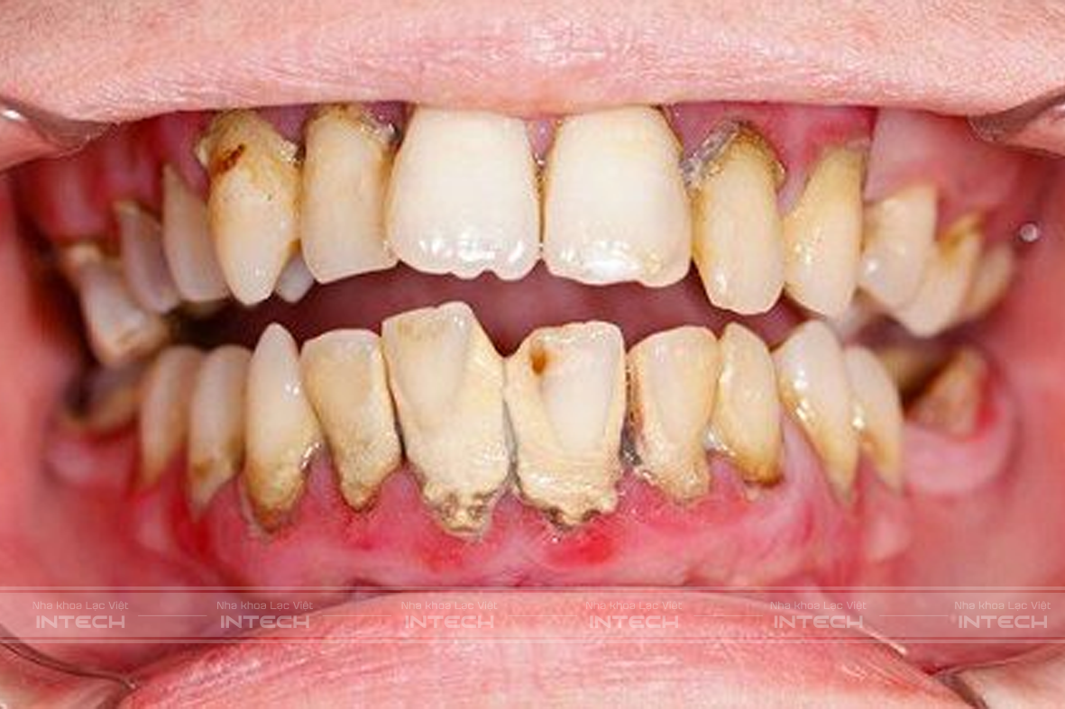 Biểu hiện viêm quanh răng