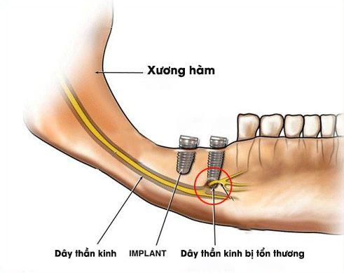 Hình ảnh minh hóa tổn thương thần kinh răng dưới do đặt trụ không chính xác