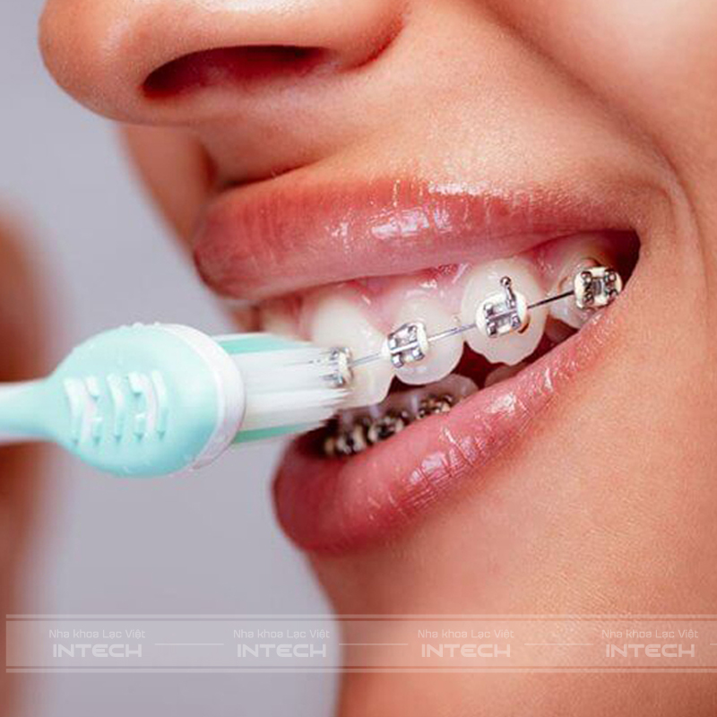 Vệ sinh răng miệng đúng cách giúp hạn chế dây chun niềng răng bị vàng