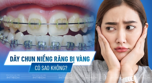 Dây thun niềng răng bị vàng: Nguyên nhân và cách khắc phục