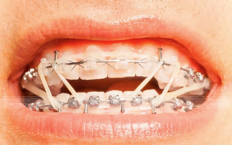 Thun niềng răng được các bác sĩ lâm sàng sử dụng từ những năm 1960
