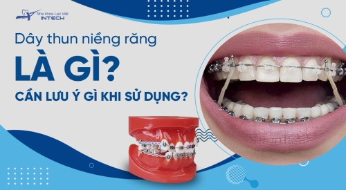 Dây thun niềng răng là gì? Phân loại và những điều cần lưu ý khi sử dụng