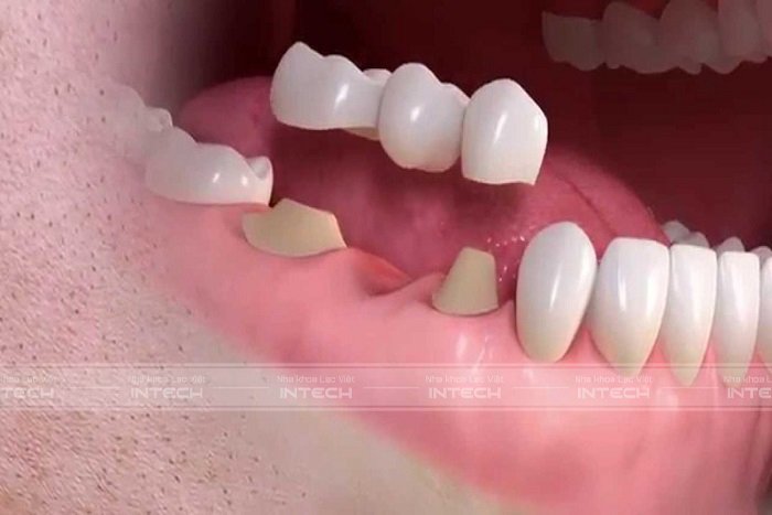Bệnh nhân có thể phải điều trị nhiều lần khi lựa chọn trồng răng bằng cầu răng sứ