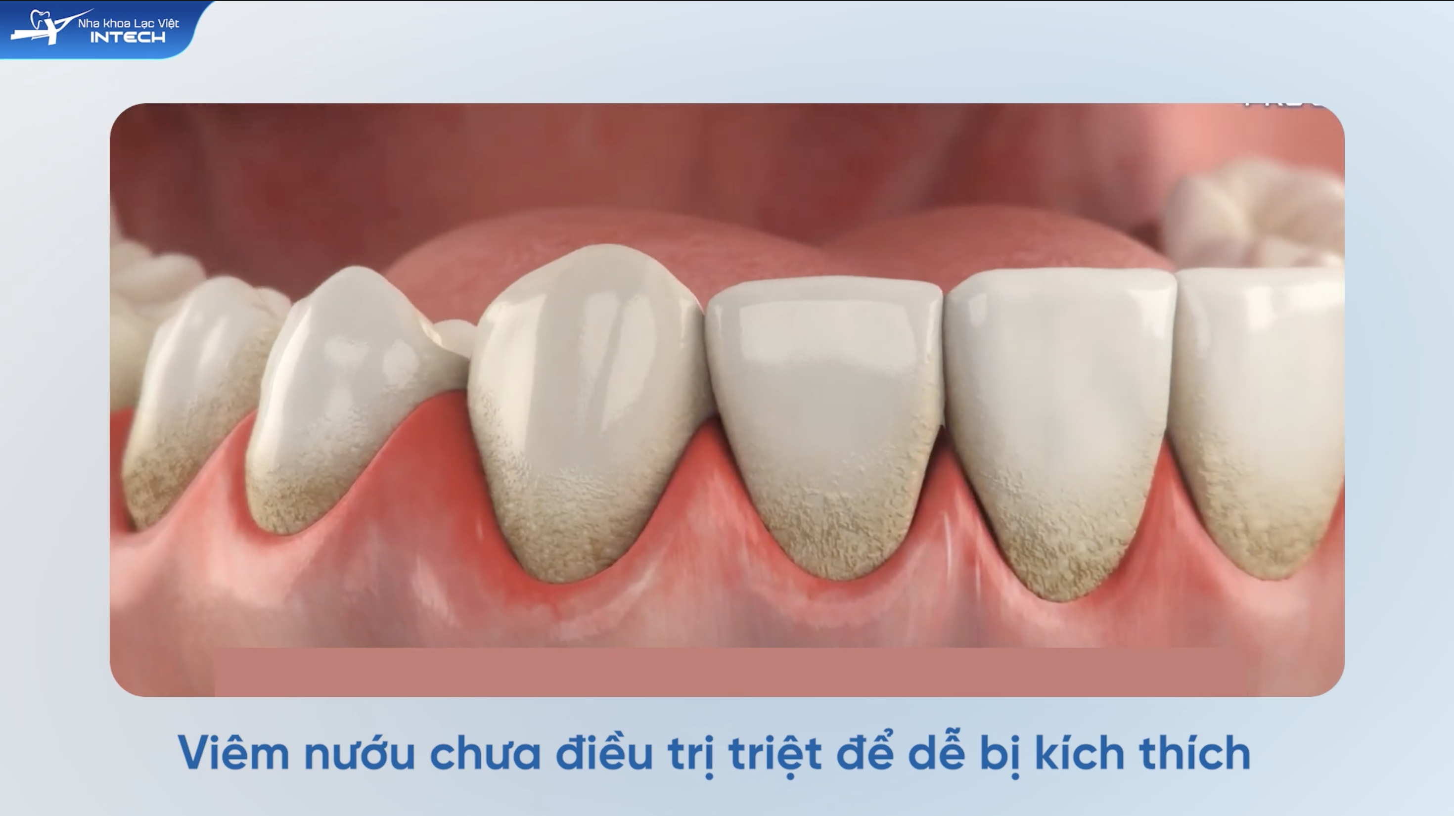 Không điều trị viêm nướu sau khi bọc sứ có thể gây đau