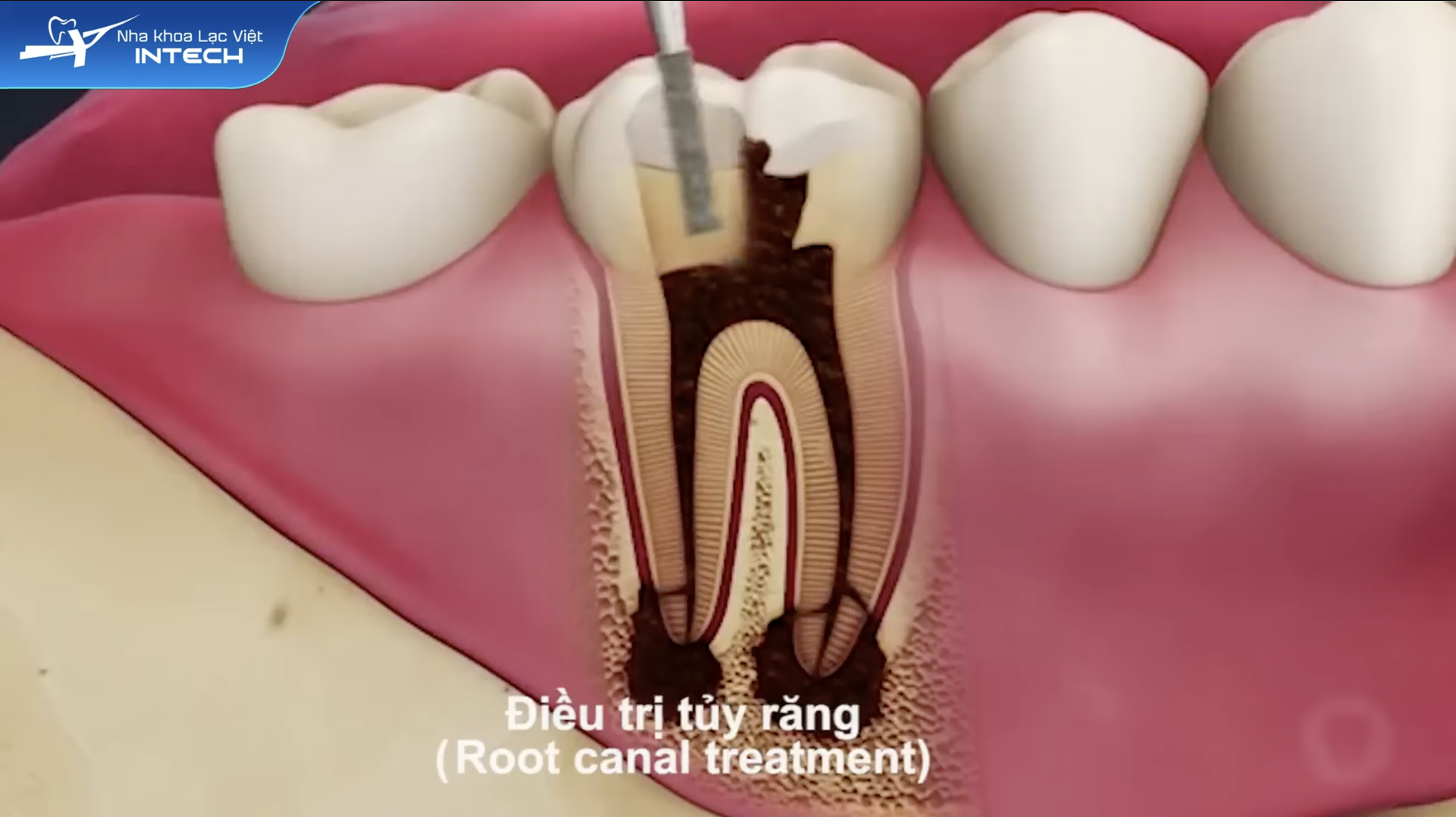 Tuỷ răng giống như “trái tim” của răng – giúp cảm nhận nhiệt độ, nuôi dưỡng cấu trúc bên ngoài. Khi bị viêm mà không điều trị kịp thời, vi khuẩn có thể lan rộng, gây tiêu xương hàm và mất răng vĩnh viễn.
