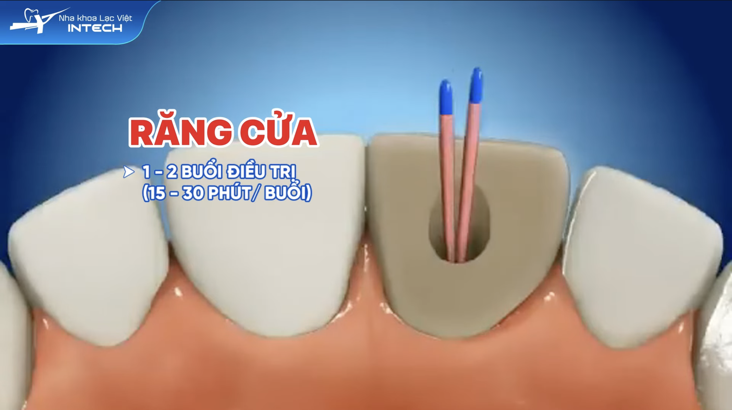 Điều trị tuỷ răng cửa có thể mất 1-2 buổi