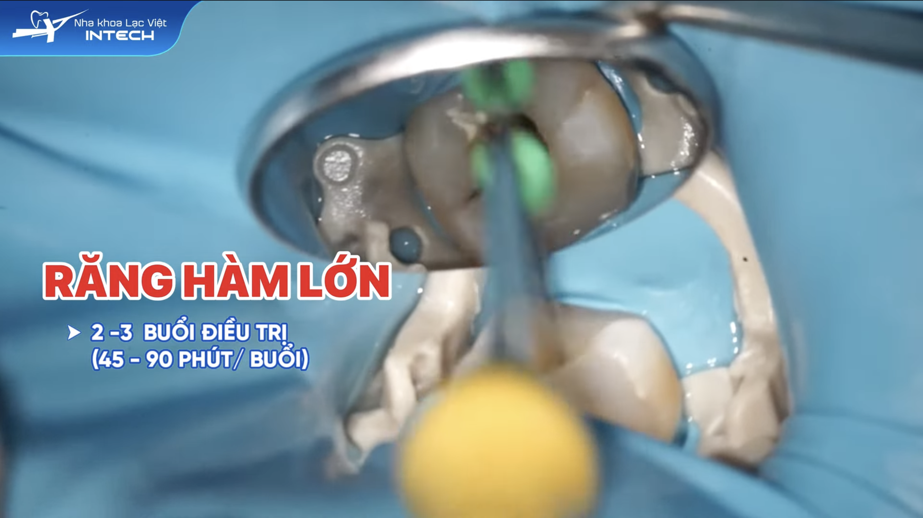 Điều trị tuỷ răng hàm lớn có thể mất 2-3 buổi