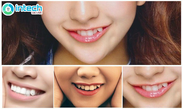 ĐÍNH ĐÁ RĂNG KHỂNH LÀM NỔI BẬT NÉT DUYÊN TỰ NHIÊN KHI CƯỜI
