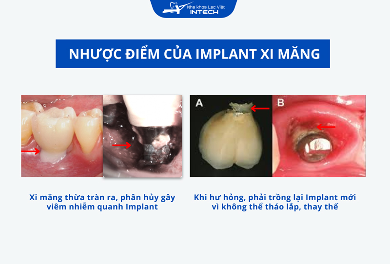 Do lượng thừa xi măng không xử lý kỹ, phương pháp này có thể gây viêm nhiễm quanh chân răng, dẫn đến phải trồng lại một răng Implant mới