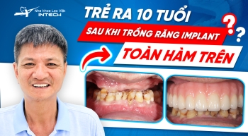 Cuộc sống trở nên ý nghĩa hơn kể từ khi trồng răng toàn hàm trên