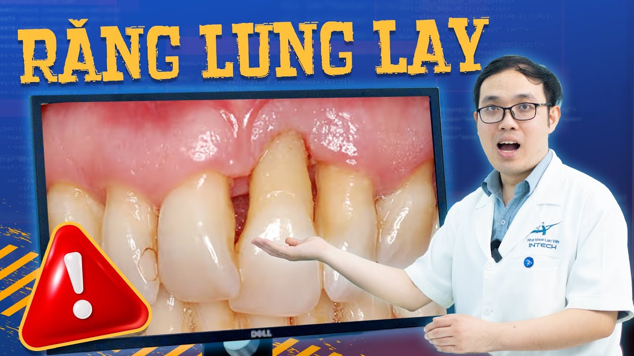Răng lung lay: Nguyên nhân, dấu hiệu và cách phòng ngừa hiệu quả