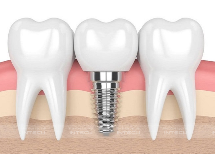 Gắn răng tạm trên implant là điều cần thiết 