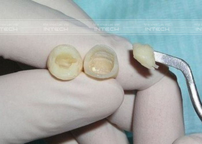 Bệnh nhân có thể gắn răng tạm thời từ sau 4 đến 5 ngày