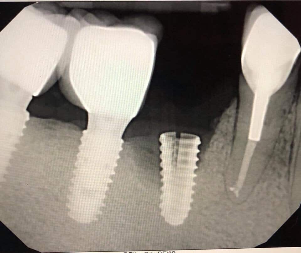 Gãy vỡ cổ implant bắt buộc sẽ phải tháo ra và cấy lại.