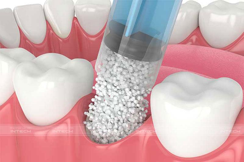 Ghép xương giúp bổ sung lượng xương bị thiếu hụt, tiêu biến khi mất răng lâu ngày