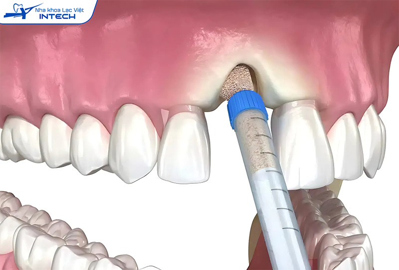 Ghép xương Implant là gì? Lợi ích, quy trình và chi phí ghép xương trong cấy ghép implant
