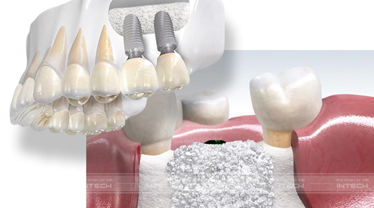 Cần ghép xương để trồng răng implant khi xương hàm quá mỏng