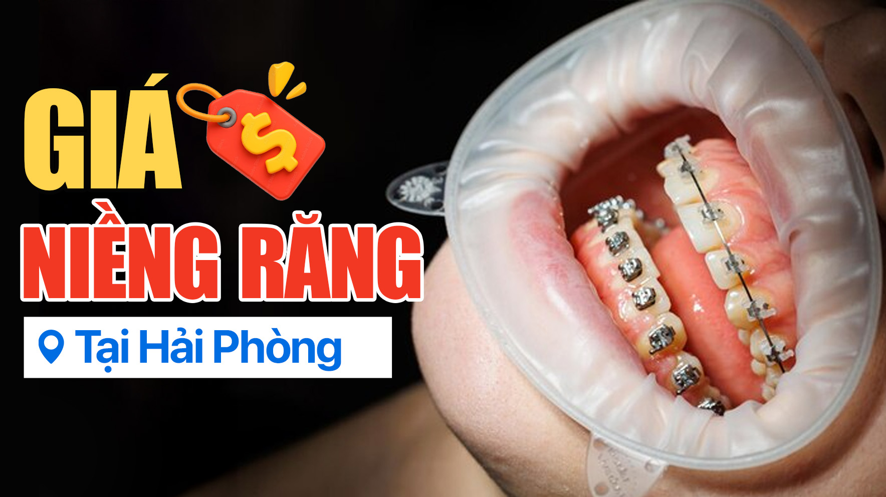Giá niềng răng tại Hải Phòng là bao nhiêu? Nên niềng răng ở đâu? 