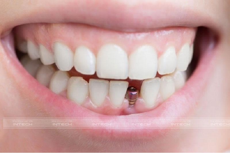 Chi phí trồng răng cửa hết bao nhiêu phụ thuộc vào từng trường hợp