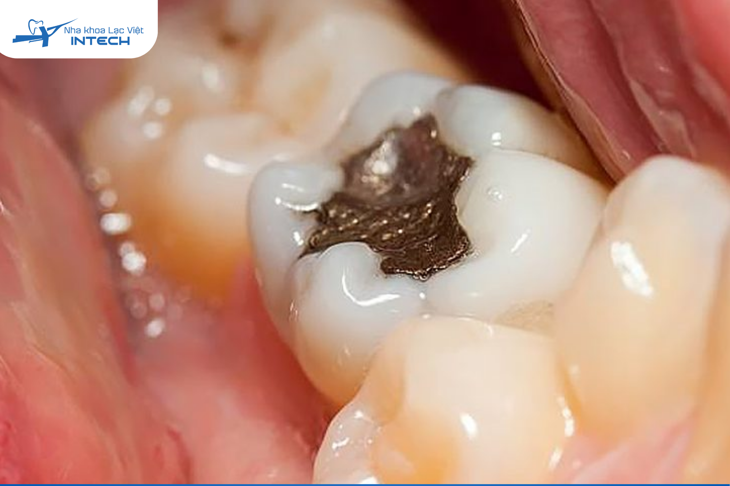 Phương pháp trám răng (hàn răng) được áp dụng khi răng số 6 bị sâu nhẹ chưa ảnh hưởng đến tủy