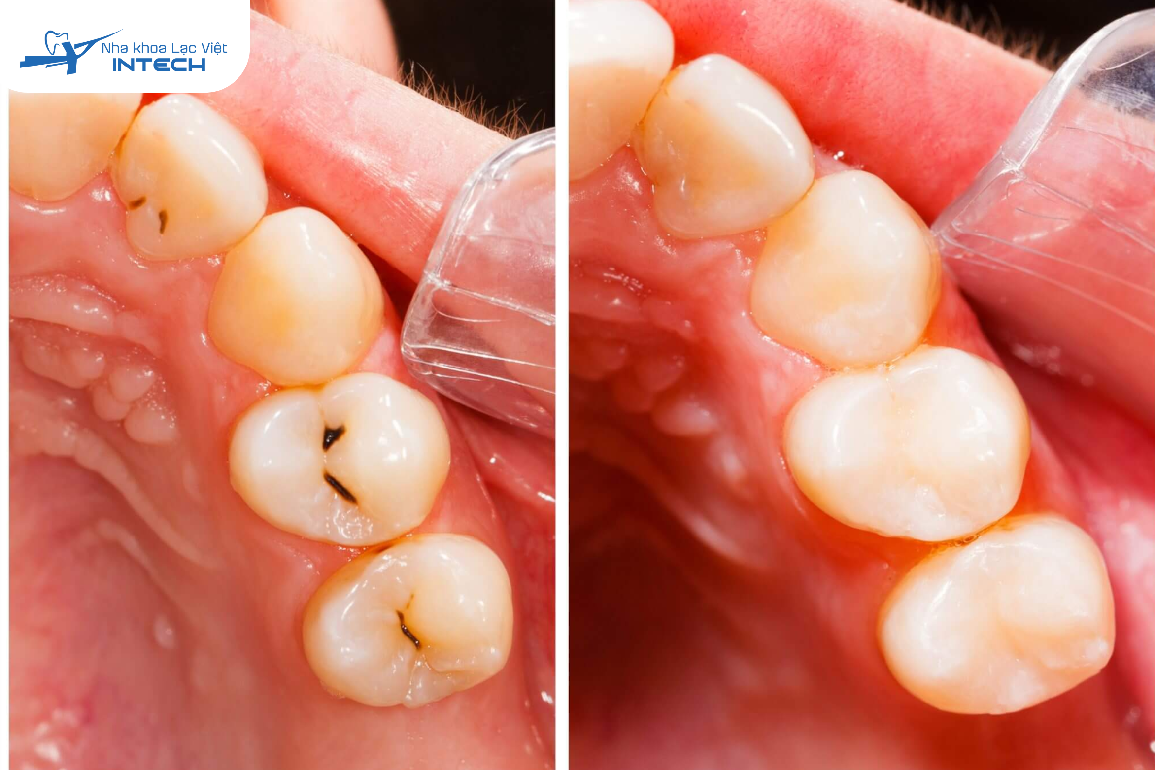 Hàn răng là một thủ thuật nha khoa phổ biến giúp khôi phục cấu trúc, chức năng và thẩm mỹ của răng bị tổn thương