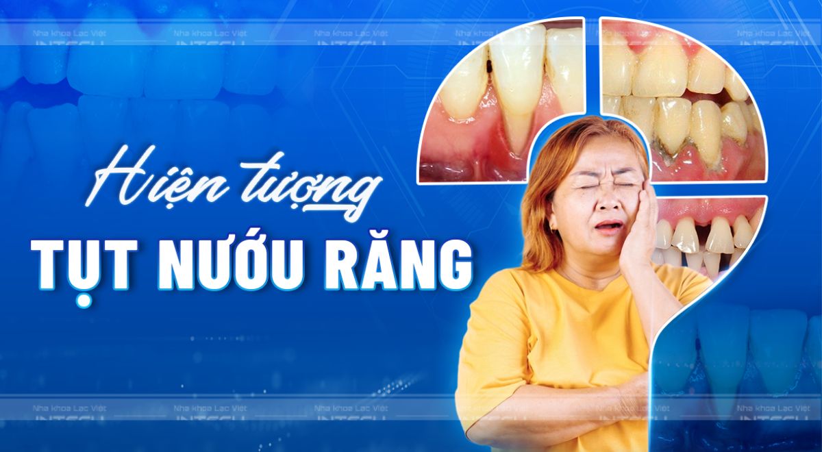 Tụt nướu răng: Nguyên nhân - Biểu hiện - Cách điều trị