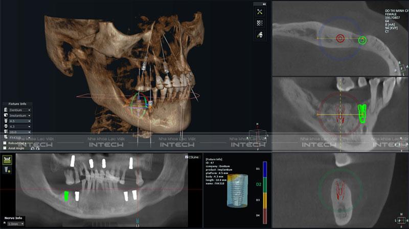 Hình ảnh phim chụp X-quang trước khi trồng răng Implant của cô Cầm và kế hoạch điều trị của bác sĩ