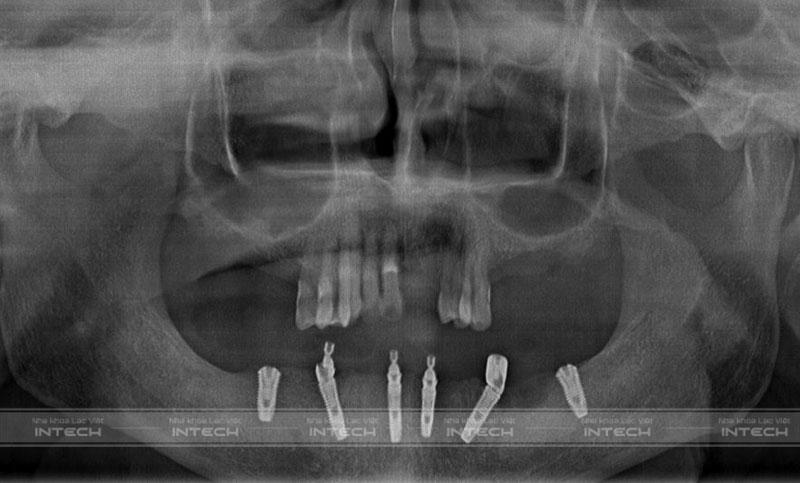 Hình ảnh phim chụp X-quang của chú Quản Văn Nghiệp sau cấy ghép Implant All-on-6 toàn hàm dưới