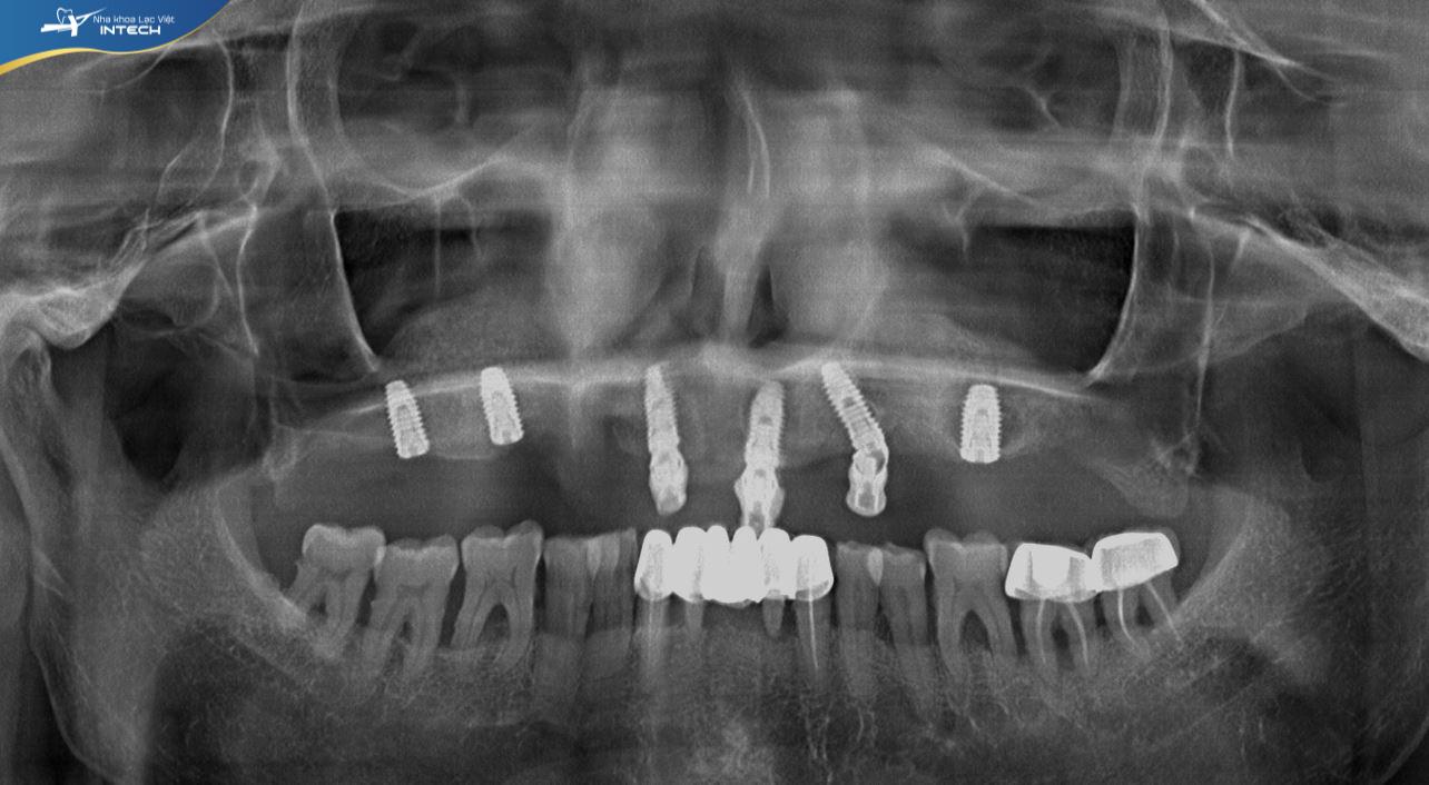 Hình ảnh phim chụp X-quang của chú Phương sau khi trồng Implant All On 6