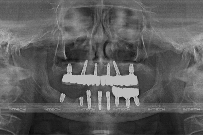 Hình ảnh phim chụp X-quang của chú Bảy sau khi trồng răng Implant