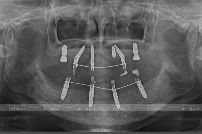 Hình ảnh phim chụp X-quang sau khi cấy Implant của cô Thủy