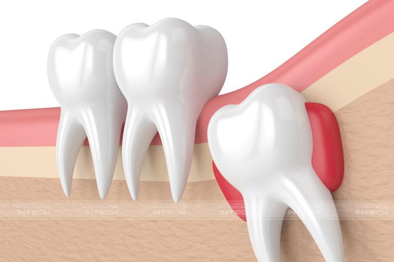 Răng khôn là chiếc răng hàm số 3 mọc cuối cùng trong cung hàm