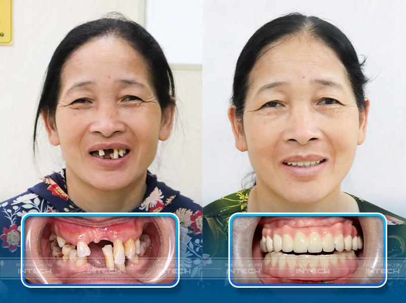 Hình ảnh so sánh cô Thủy trước và sau khi trồng răng Implant tại Lạc Việt Intech