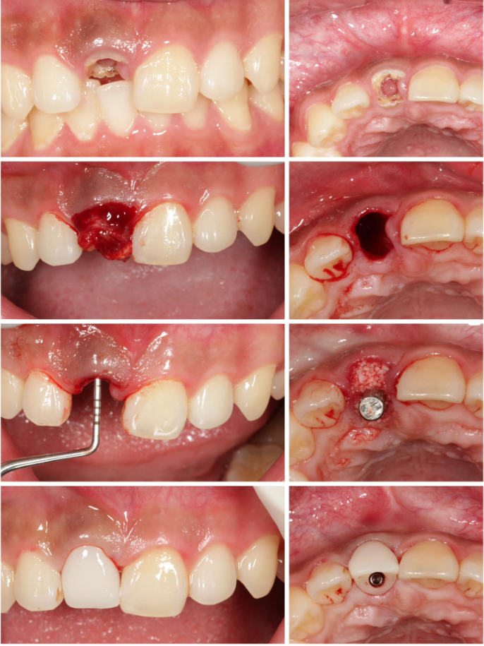 Một ca phục hình cấy ghép Implant tức thì kết hợp ghép xương, được thực hiện đúng quy trình và đảm bảo an toàn tại Nha khoa Lạc Việt Intech