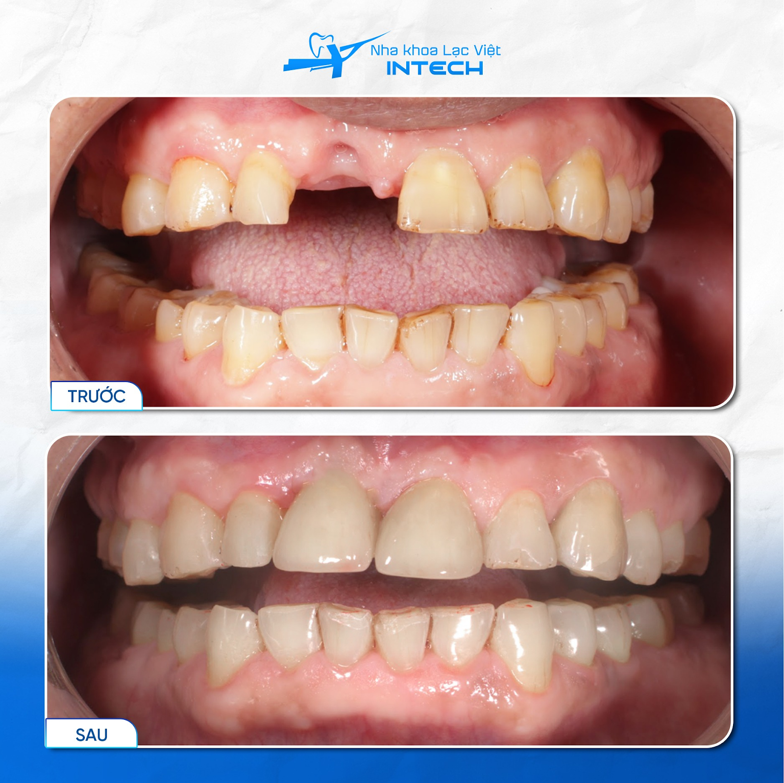 Sau khi phục hình răng đơn lẻ bằng giải pháp trồng Implant cá nhân hóa DCT, chú Trần Hồng Tuyến đã có chiếc răng mới thẩm mỹ ăn nhai tốt
