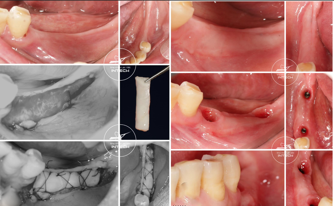 Thủ thuật ghép lợi trước khi cấy ghép Implant được thực hiện an toàn, chính xác tại nha khoa Lạc Việt Intech