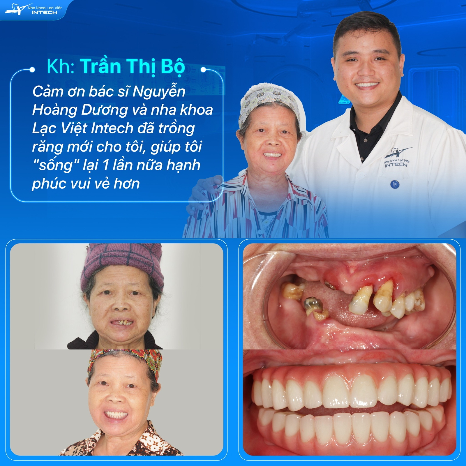 Nhờ điều trị bằng phương pháp All-On-4 tại nha khoa Lạc Việt Intech, cô Trần Thị Bộ đã khôi phục khả năng ăn nhai và thẩm mỹ toàn hàm