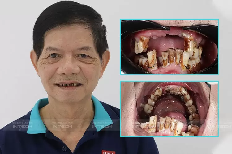 Tình trạng răng toàn hàm bị hỏng nặng, viêm nhiễm của chú Trần Văn Bình trước khi điều trị