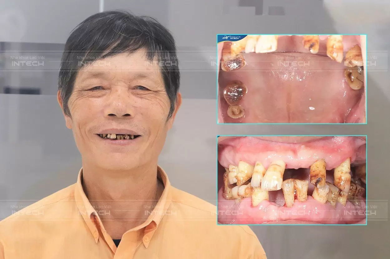 Tình trạng răng miệng toàn hàm hư hỏng nặng trước điều trị của chú Trịnh Đạt Hải