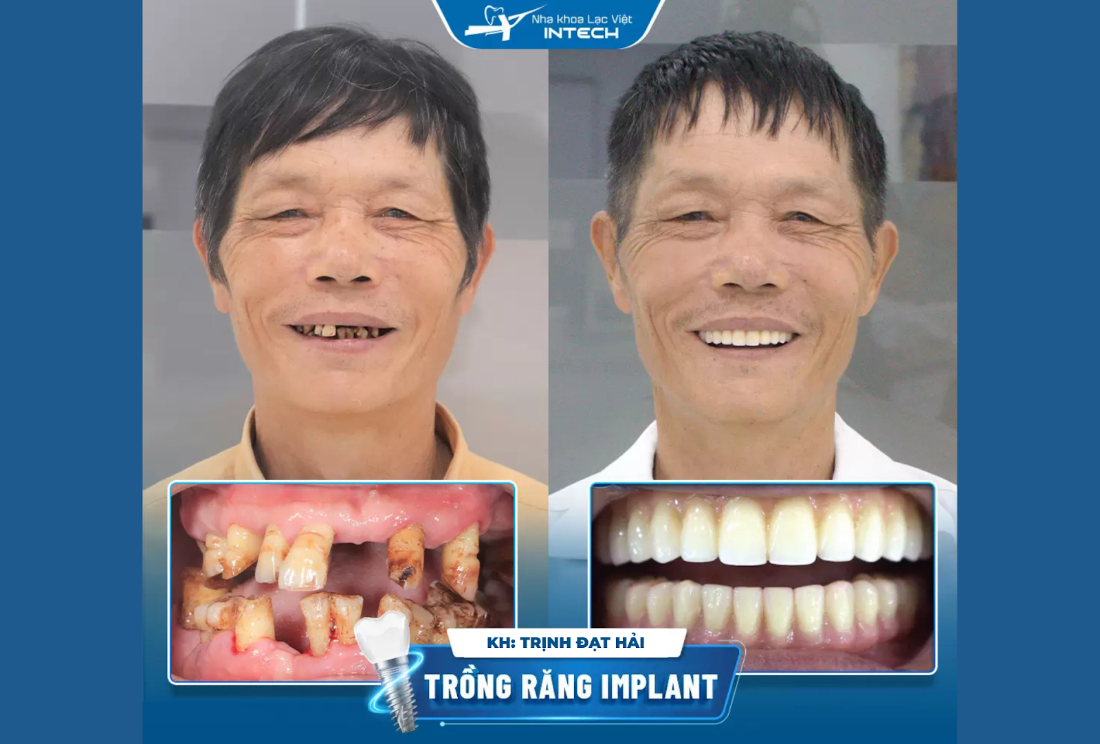 Sau khi sử dụng phương pháp All-On-6, gương mặt chú Hải trông trẻ trung hơn với hai hàm răng mới