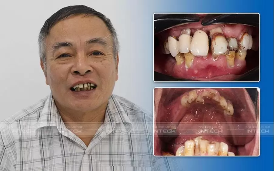 Tình trạng răng toàn hàm nghiêng lệch, tiêu xương và viêm nhiễm nặng của chú Nguyễn Duy Khích